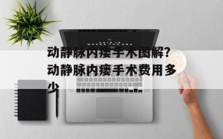 动静脉内瘘手术图解？动静脉内瘘手术费用多少